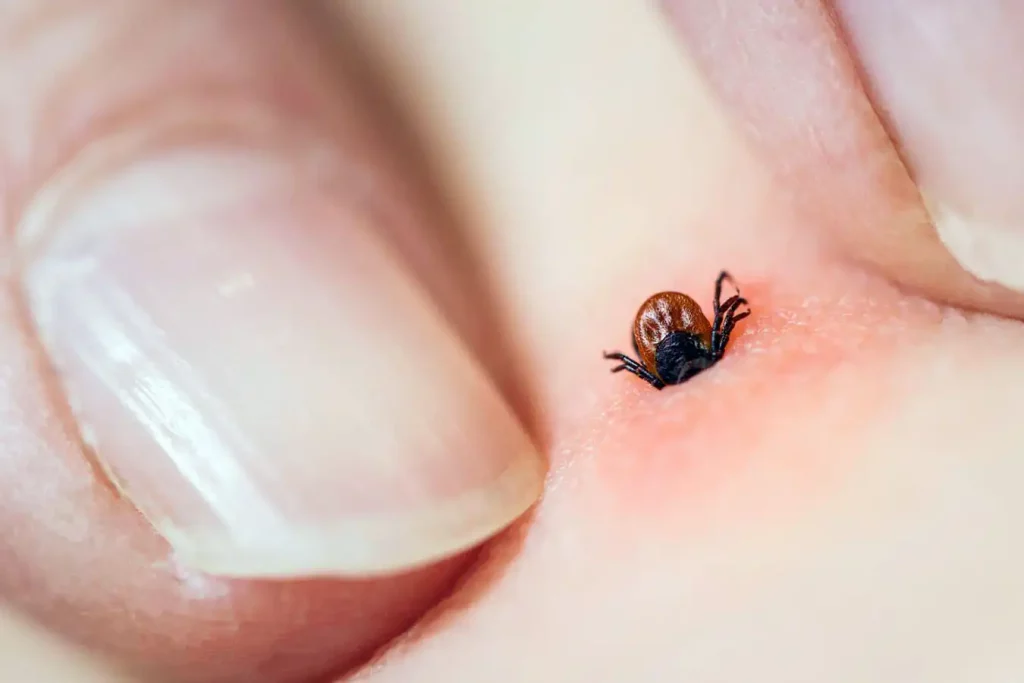 Tick bite - inflammation and irritation of the skin.