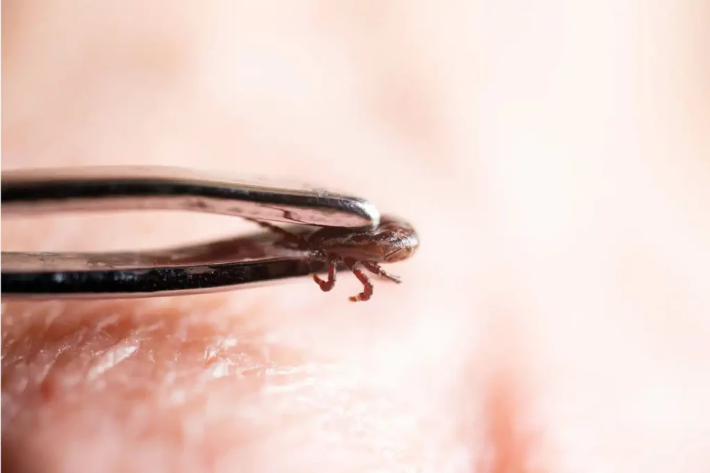 Tweezers holding a tick on a person's skin